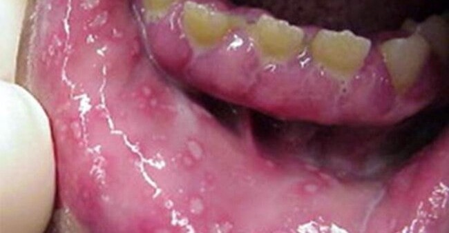Herpes sores around the mouth