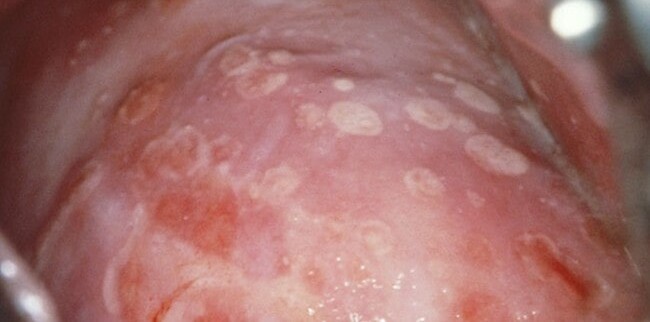 Herpes sores on the shaft of the penis