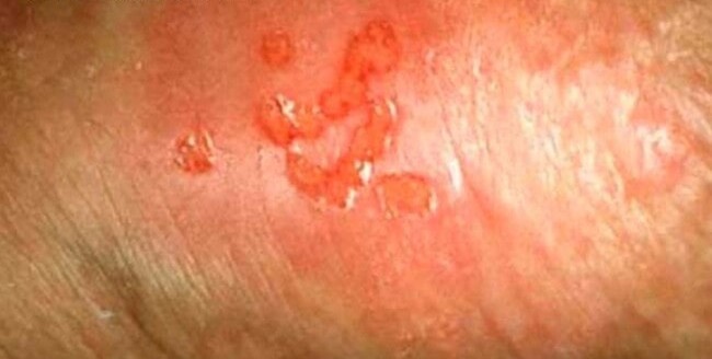 Open herpes sores on the penile shaft