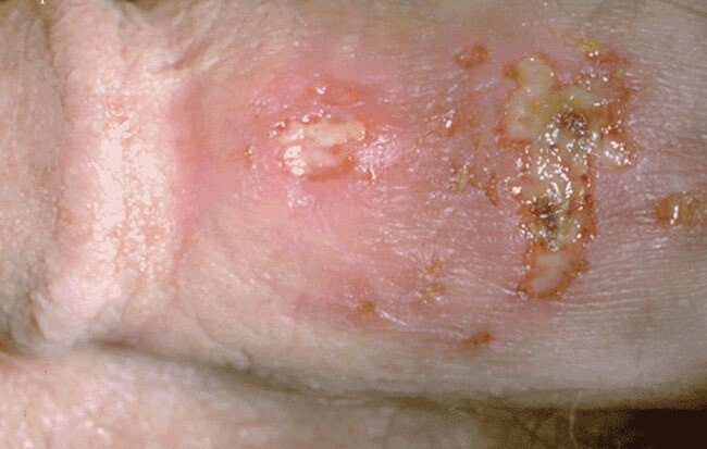 Newly formed herpes sores on the shaft of the penis