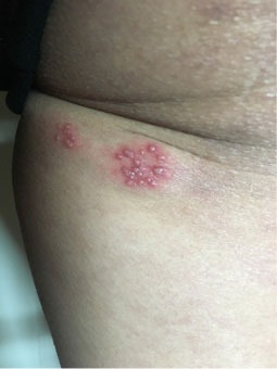 Clusters of herpes blisters on the inner thigh