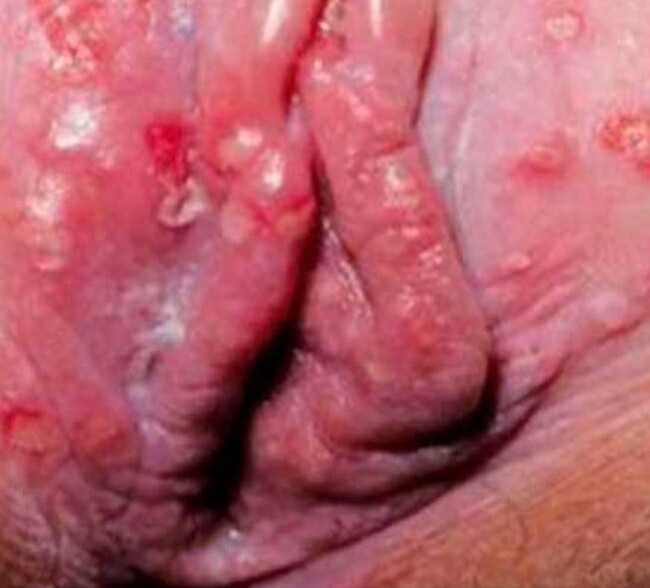 Genital herpes sores on the vaginal opening and vulva