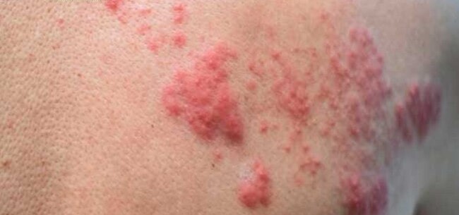 Early herpes bumps starting to turn into blisters