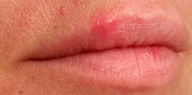 Early herpes: a red patch with two small bumps
