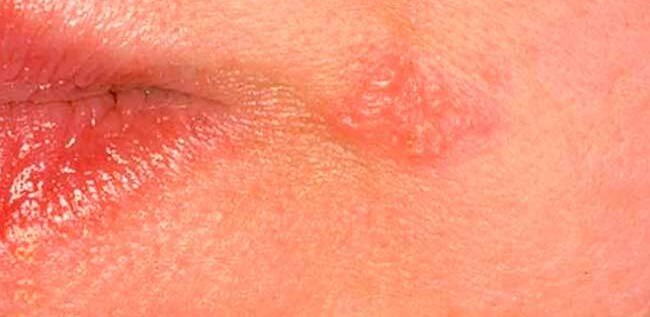 Herpes photos in different stages: stage 1, a red patch of skin before blisters form