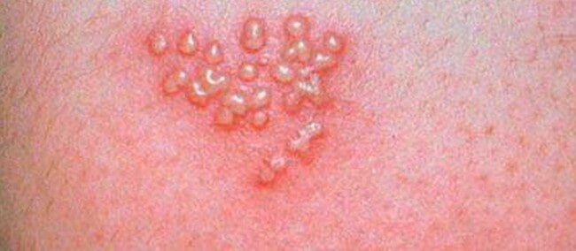 A cluster of herpes blisters about to burst