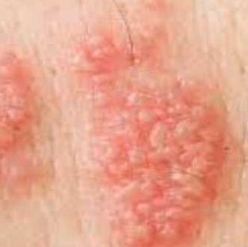 A group of herpes blisters