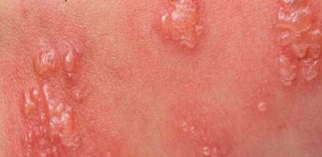 Herpes blisters about to burst and ooze