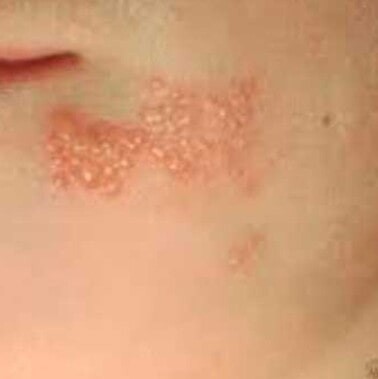 Classic herpes blisters on red skin