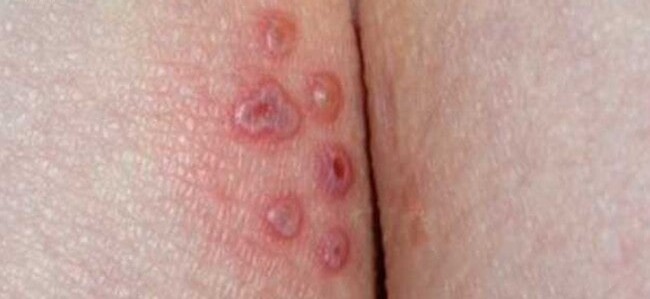 Newly opened herpes sores with the broken blister skin still visible