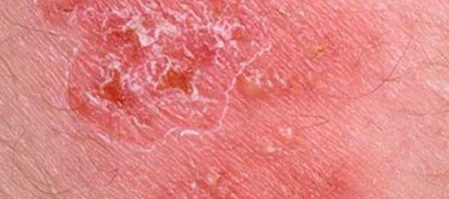 Herpes sores almost fully healed, with crust on a few spots