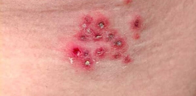 Healing herpes sores that are crusted and mostly dry