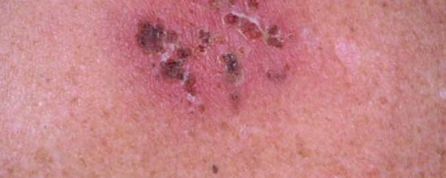 A scabbed, crusted herpes sore