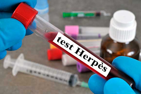 Herpes Test