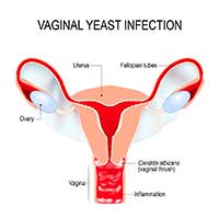 Herpes vs Vaginal Yeast Infection