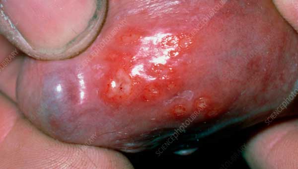 Herpes sores under the penile head