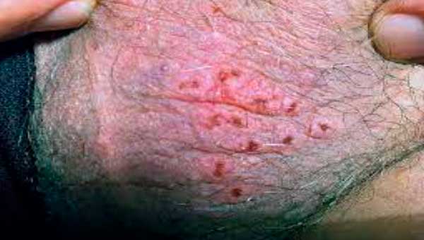 Herpes sores of the scrotum