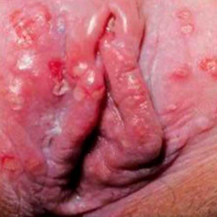 Herpes sores of the female genitalia: vulva and vagina area