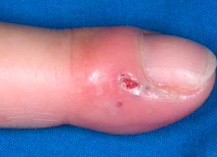Herpes of the finger: herpetic whitlow