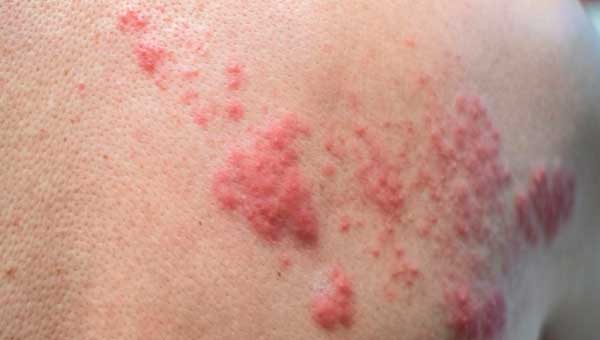 Herpes of the skin of the back