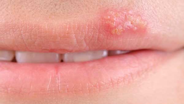 Herpes labialis: herpes of the lip