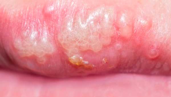 Cold sore blisters -Herpes labialis