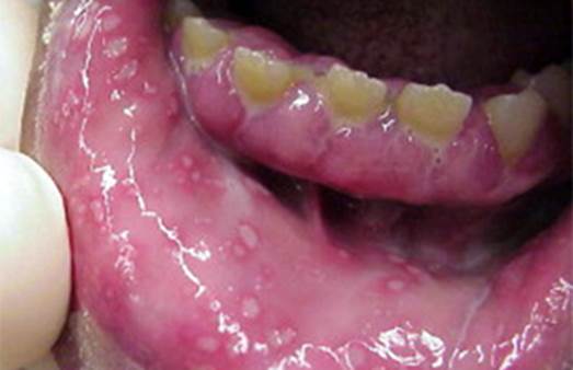 Severe oral herpes
