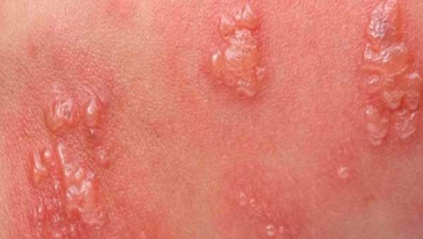 Herpes blisters that are ready to burst