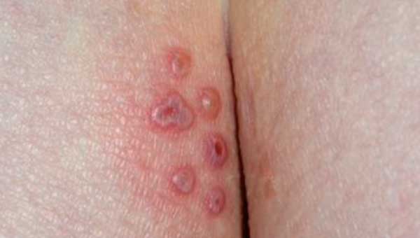 Newly formed herpes sores