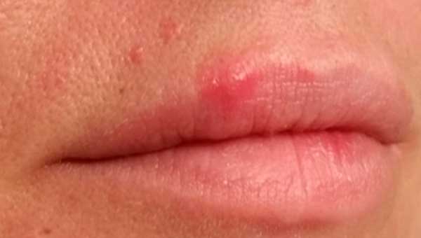 What Do Herpes Lesions Look Like Herpes In Pictures