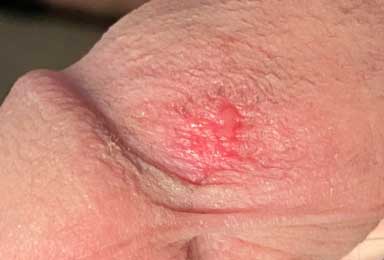 A friction burn was around the left inguinal region.