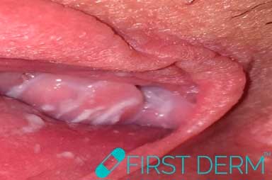 Genital friction blister-or something else, like herpes or an