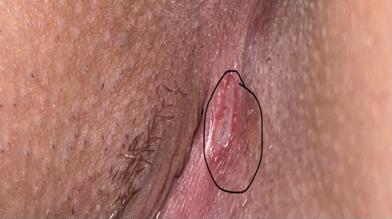 Vaginal cuts or wounds