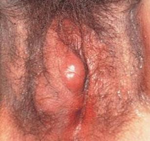 Bartholin abscess, or cyst
