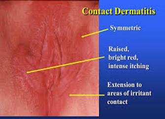 Contact dermatitis