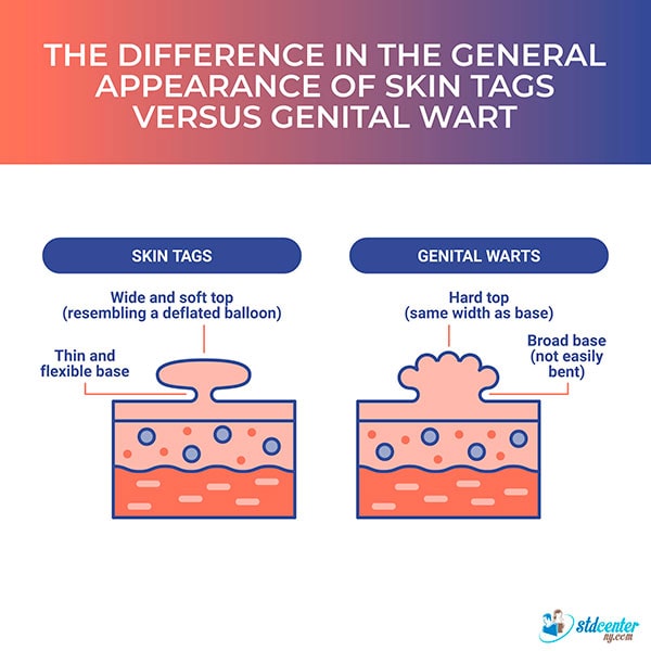 The difference in the general appearance of skin tags versus genital wart.