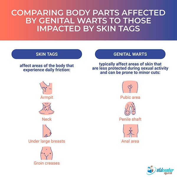 Comparing body parts affected by genital warts to those impacted by skin tags.