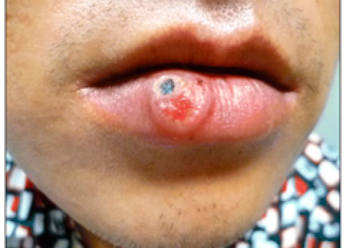 Syphilis sore on the lip