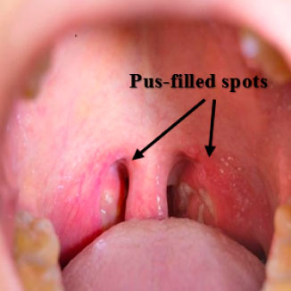 Oral gonorrhea photo