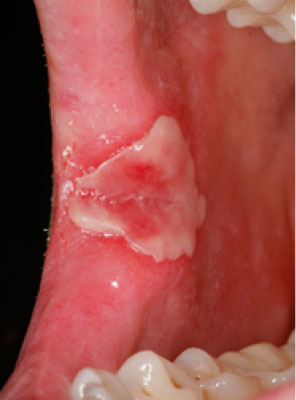 secondary syphilis white oral patches