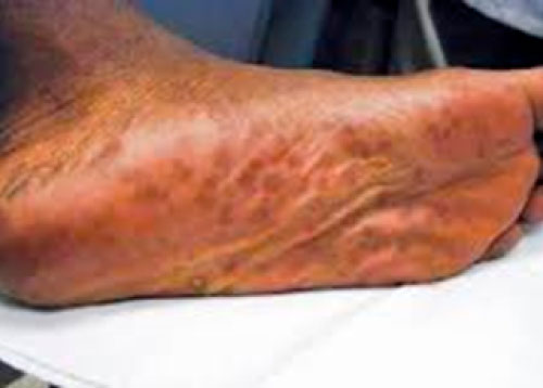 Secondary syphilis rash affecting the palms and soles