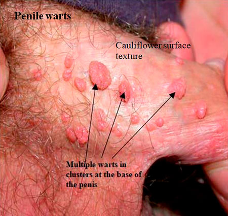 genital warts on testicles