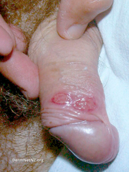 two syphilis sores with well-defined borders