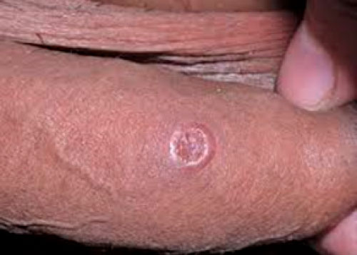 Penile syphilis chancre
