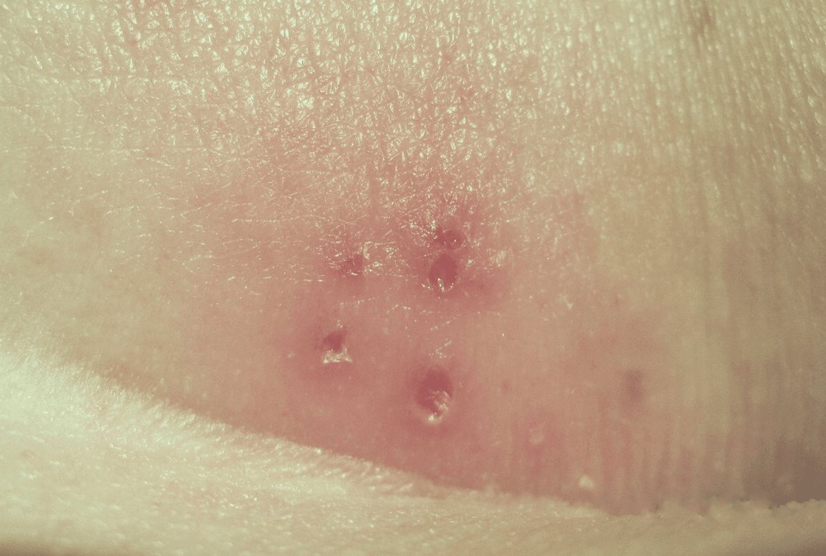 Recurrent herpes outbreak with a few small sores close together