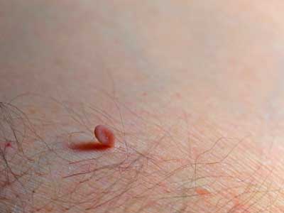 Photos of skin tags and genital warts