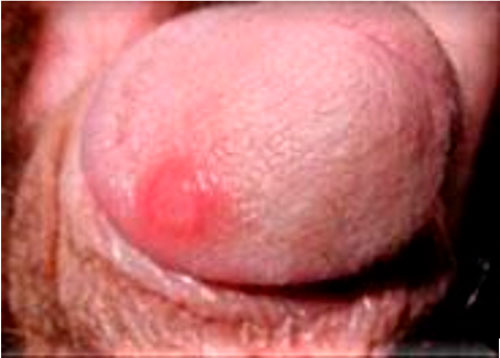 Syphilis bump