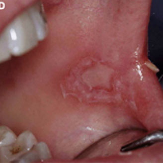 secondary syphilis white oral patches