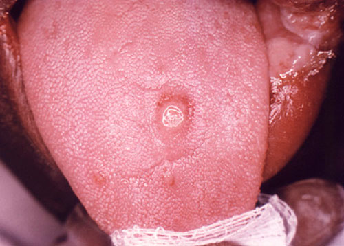Syphilis sore of the tongue