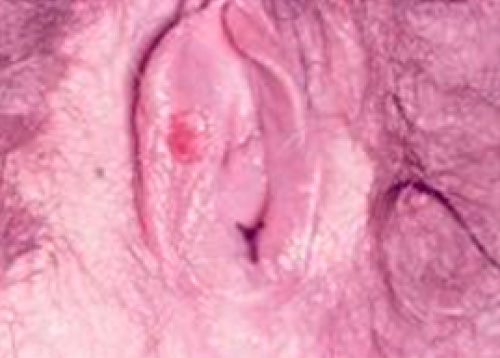  syphilis sore on the vagina wall